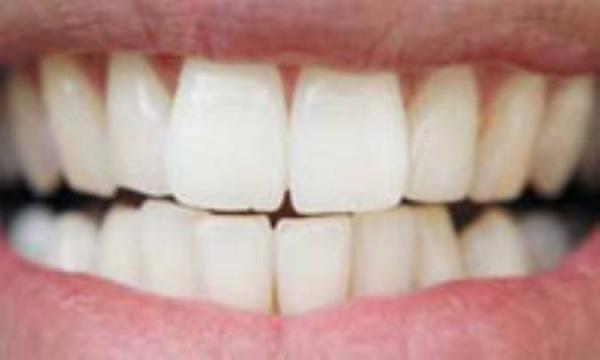 دلیل سایش دندانی